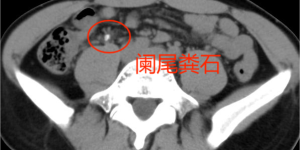 一汽总医院完成省内首例日间手术模式下电子胆道镜联合肠镜阑尾炎取石术