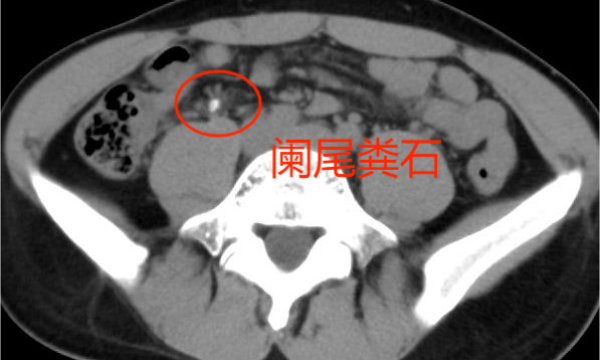 一汽总医院完成省内首例日间手术模式下电子胆道镜联合肠镜阑尾炎取石术